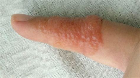Dyshidrotic Eczema Overview Causes Diagnosis And Pictures In 2020