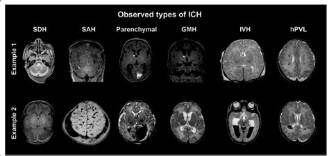 Observed Types Of Ich Mr Images Show Two Sets Of Examples For