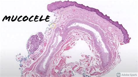 Mucous Retention Cyst Lip Histology Sitelip Org