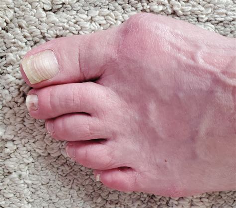 Mksap Quiz Pain In Left Great Toe Acp Internist