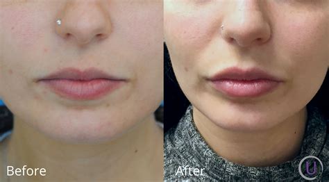 Before And After For Lip Augmentation With Restylane Silk One Week
