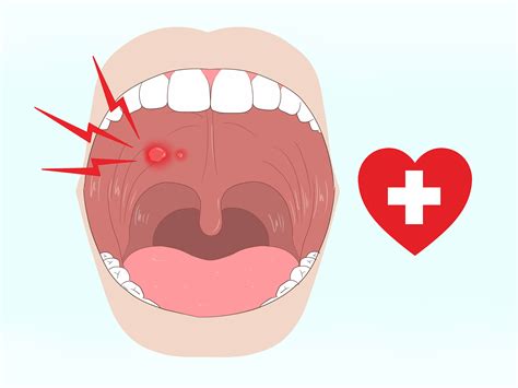 Other types of sores in the mouth can resemble blood blisters and. 3 Ways to Get Rid of Mouth Blisters - wikiHow