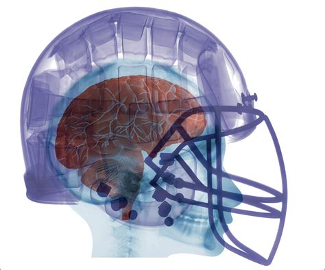 Traumatic Brain Injury In 2017 Exploring The Secrets Of Concussion