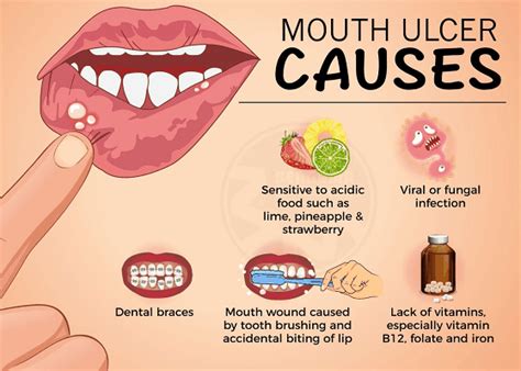 What Causes Mouth Ulcers And How To Treat Them