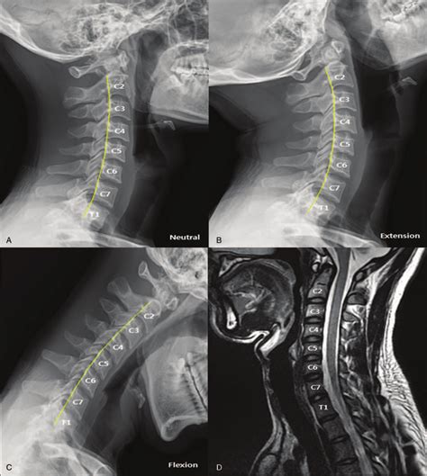 Cervical Dynamic Radiographs And Magnetic Resonance Images Mris A