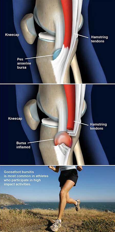 Goosefoot Pes Anserine Bursitis Of The Knee Central Coast Orthopedic Medical Group