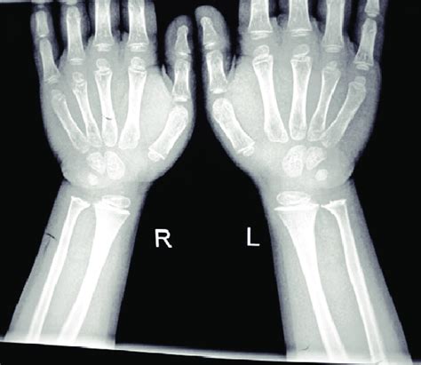 Top 93 Pictures Normal X Ray Of Hand And Wrist Sharp 102023