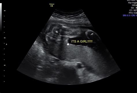 24 Week Gender Ultrasound Confusion