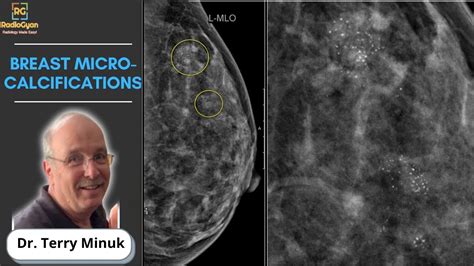 Mastering Mammography Understanding Breast Micro Calcifications Dr Terry Minuk Youtube