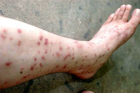 Sand Flea Bites On Humans Symptoms And Treatment