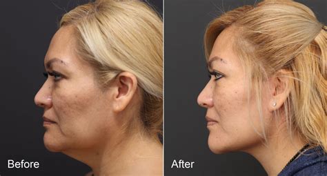 Neck Lift Before And After Photos Nicole Schrader Md Facs