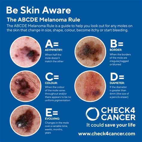 Dont Get Burned Be Aware Of Melanoma And Skin Cancer