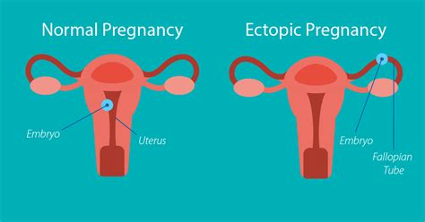 Managing An Ectopic Pregnancy St Luke S Health