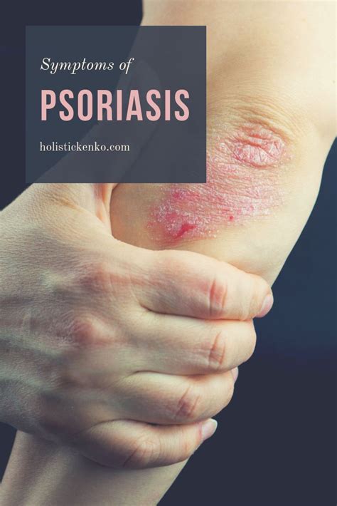 Psoriasis Is A Chronic Inflammatory Autoimmune Skin Disease Affecting 2