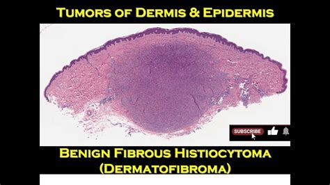 8m Benign Fibrous Histiocytoma Dermatofibroma Youtube