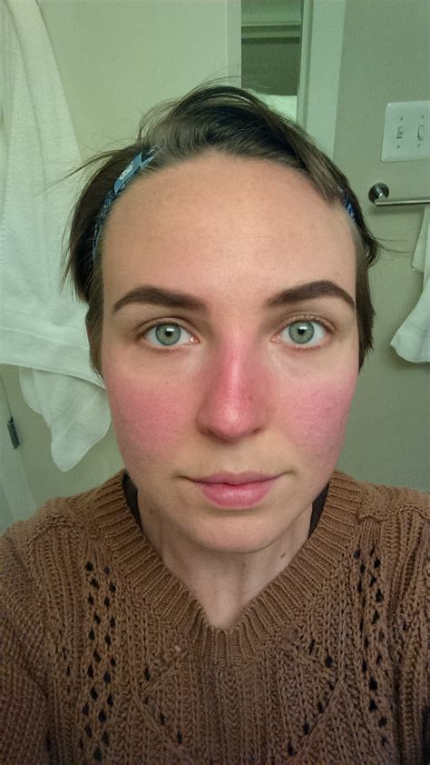 Routine Help Recently Diagnosed With Rosacea Have Been Slowly
