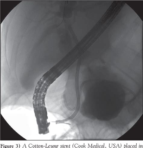 Figure 1 From Pancreatic Pseudocyst With Fistula To The Common Bile