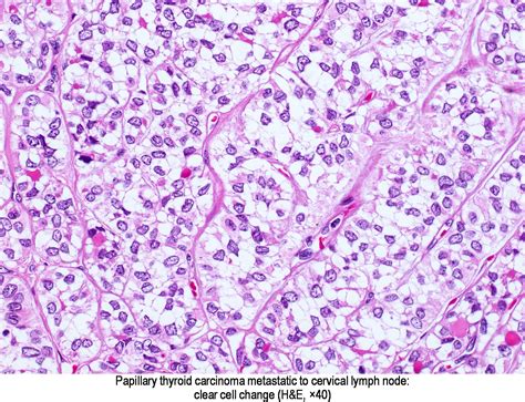 Pathology Outlines Papillary Carcinoma General