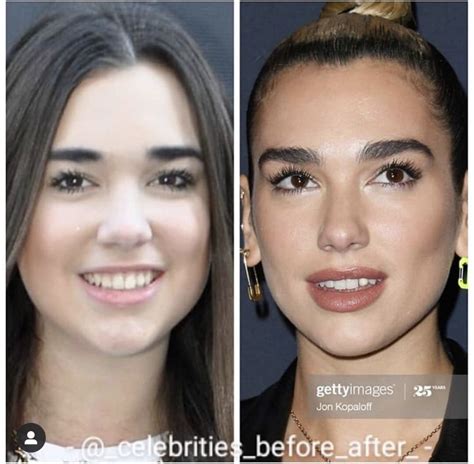 Dua Lipa Celebrity Plastic Surgery Celebrities Before And After