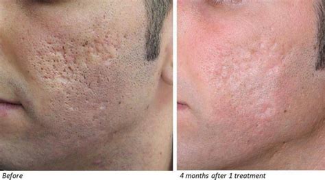 Acne Scar Treatment With Co2 Laser