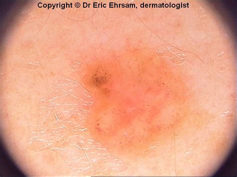 Dermoscopy Basal Cell Carcinoma