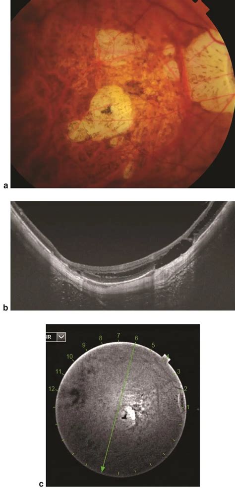 Posterior Staphyloma American Academy Of Ophthalmology