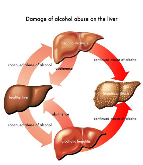 Alcoholic Hepatitis Causes Diagnosis Treatment And More Nutriplus LivHealth QNET India