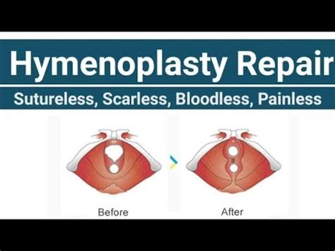 Hymenoplasty Results Hymen Repair In Jaipur YouTube