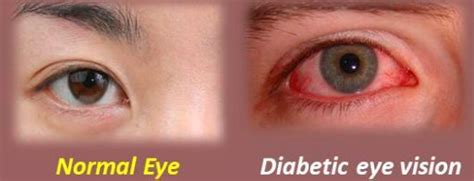 How Can Red Eyes Be A Sign Of Diabetes Quora