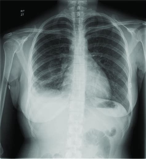 Chest Roentgenogram Following Biopsy Download Scientific Diagram