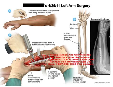 Amicus Illustration Of Amicus Surgery Arm Ulna Dissection Submuscular