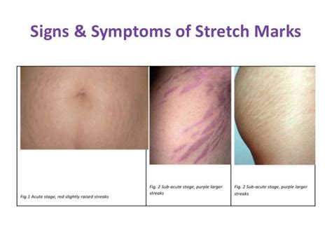 How To Deal With Stretch Marks