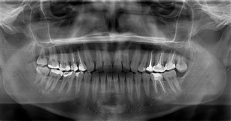 Воспаление корня зуба фото С большим количеством иллюстраций