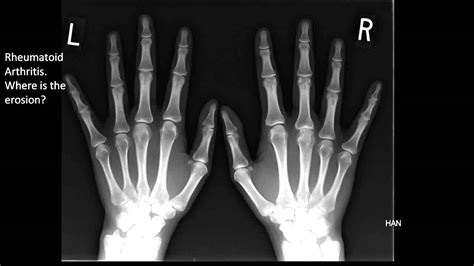 Image Of The Month Rheumatoid Arthritis X Ray Youtube