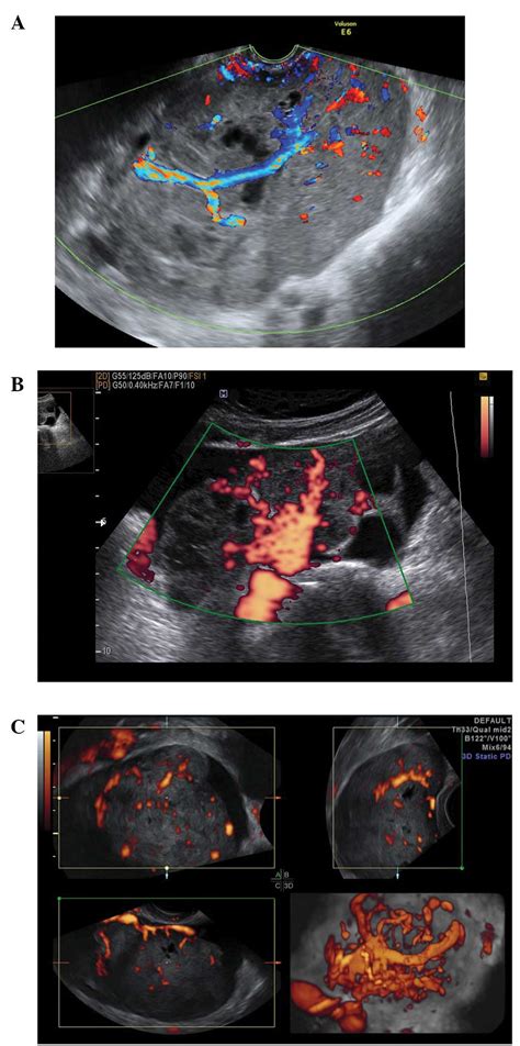 Ovarian Cancer Ultrasound Of Ovaries With Cyst Sonographic Assessment