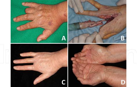 Figure 3 From Chapter 5 Current Surgical Management Of Acral