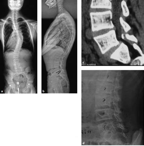 11 Adolescent Spondylolisthesis Associated With Scoliosis Which