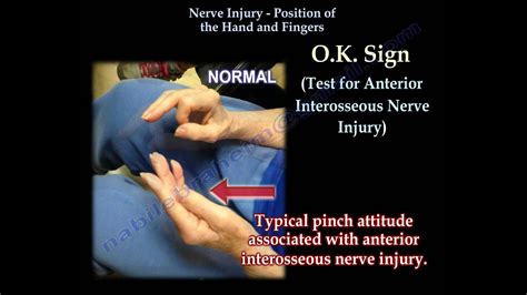 Nerve Injury Positions Of The Hand Everything You Need To Know Dr