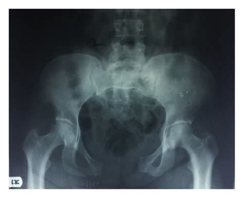 Pelvic X Ray Showing Wide Pubic Diastasis Fractured Left Upper Ischial