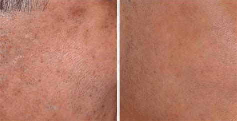 Enlarged Pores Treatment Nyc Manhattan Goldenberg Dermatology
