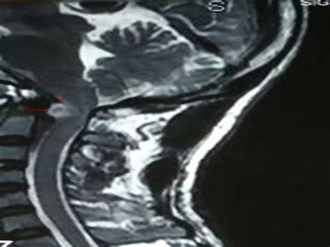 Craniovertebral Junction Cord Compression Due To Neurofibroma Bmj