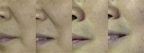 Classification Of Nasolabial Folds In Asians And The