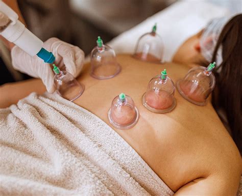 Cupping Therapy Definition Types And Benefits