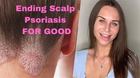 Ending Scalp Psoriasis For Good 🤩 Youtube