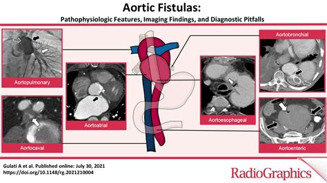 Aortic Fistulas Pathophysiologic Features Imaging Findings And