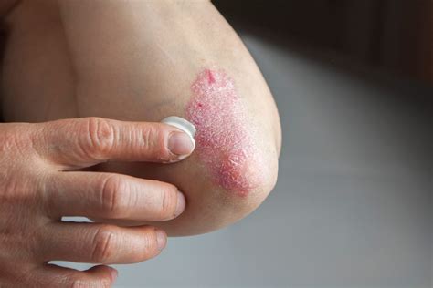 Psoriasis A Guide To Symptoms Causes Types Treatments The Healthy
