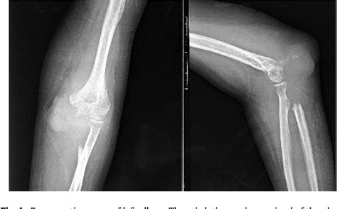 Figure 1 From A Giant Cell Rich Osteosarcoma Of The Proximal Ulnar Bone