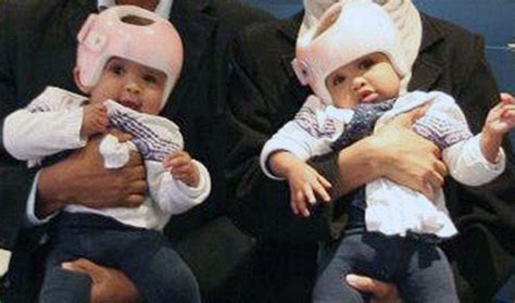 Conjoined Twins Rital And Ritag Gaboura Beat Odds And Survive Surgical