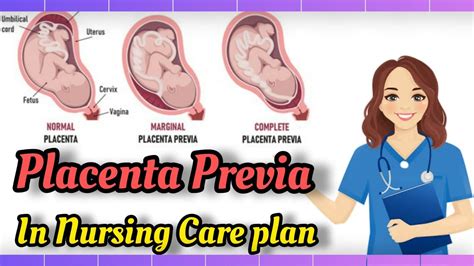 Placenta Previa With Nursing Care Plan Nursing YouTube