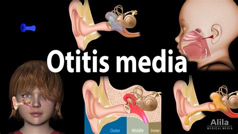 Otitis Media Anatomy Pathophysiology Risk Factors Types Of Om